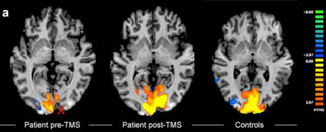 an image of a brain scan show three different states